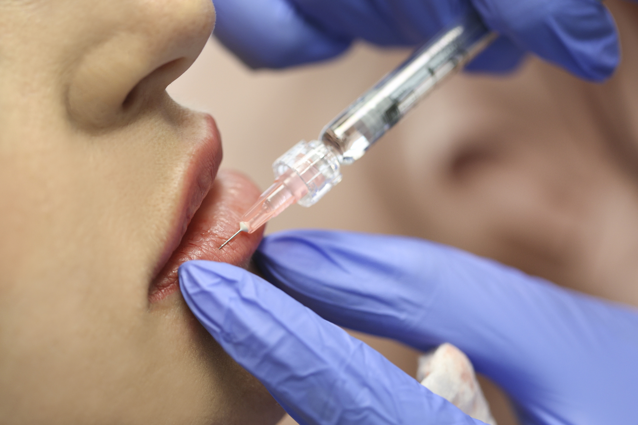 Lip filler aftercare