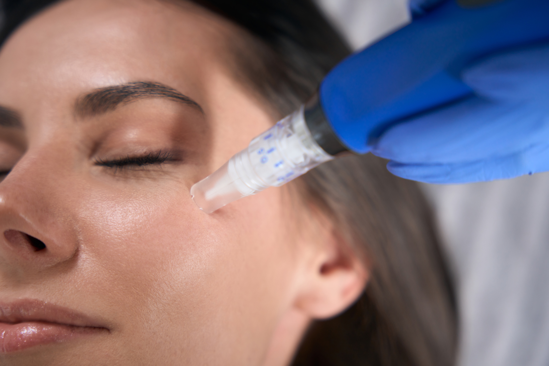 Do You Need Numbing Cream for Microneedling? A Practitioner’s Guide 1 numbing cream for microneedling